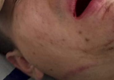 Joven pudahuelino pierde siete piezas dentales tras recibir golpiza de Carabineros