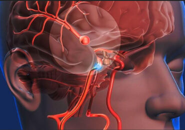 Ataque Cerebro Vascular: La rapidez en la atención es clave para una recuperación exitosa o disminuir secuelas
