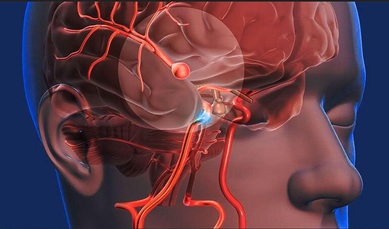 Ataque Cerebro Vascular: La rapidez en la atención es clave para una recuperación exitosa o disminuir secuelas